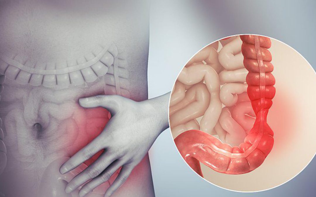 Alternative Treatment for IBS – Exploring Functional Medicine