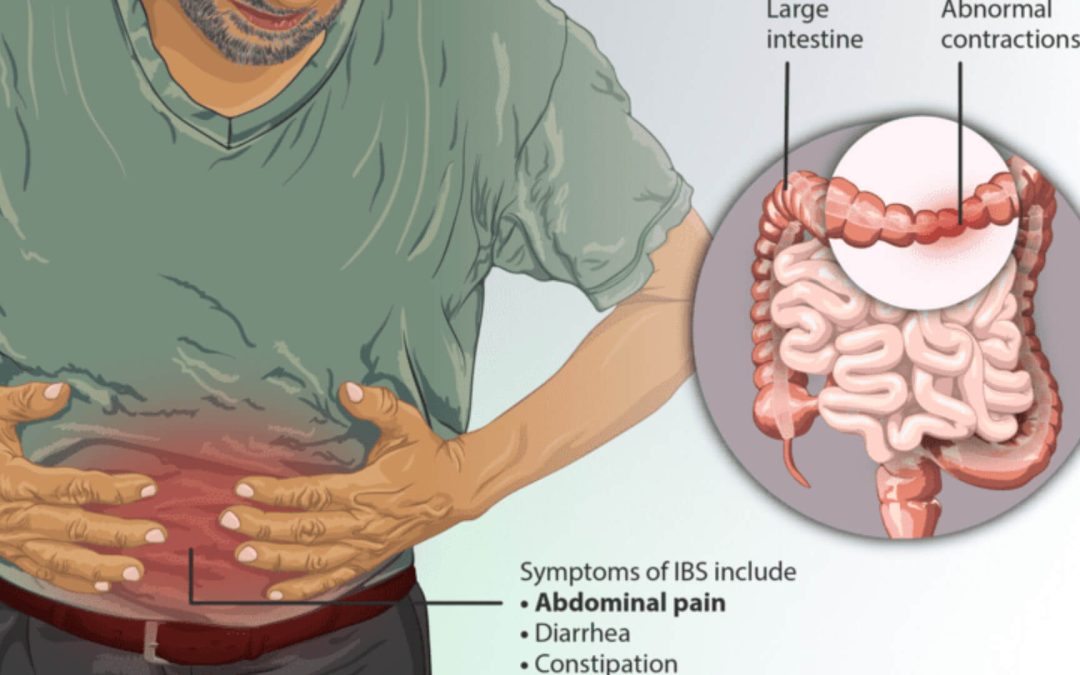 Alternative Treatment for IBS through Functional Medicine